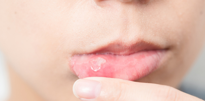 Woman suffer from mouth aphtha